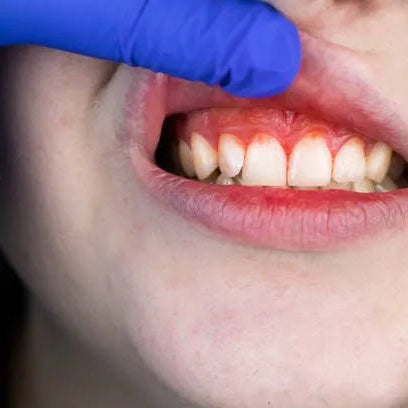 Remèdes Naturels Pour Traiter La Récession Gingivale - nilabeautys.com