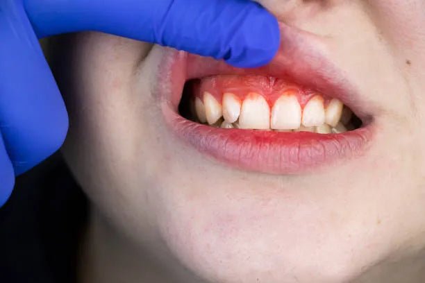 Remèdes Naturels Pour Traiter La Récession Gingivale - nilabeautys.com